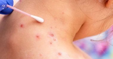 الصحة العالمية: 131 إصابة مؤكدة بجدرى القرود و106حالات اشتباه فى 19 دولة