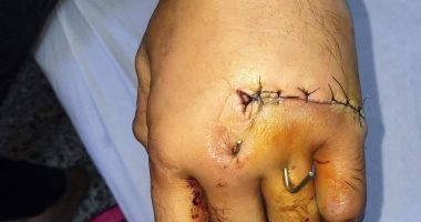 نجاح إعادة كف يد شخص بعد بترها فى مشاجرة بـ"طوارئ المنصورة"