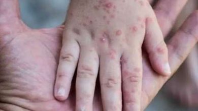 أعراض الإصابة بجدري القرود - أرشيفية