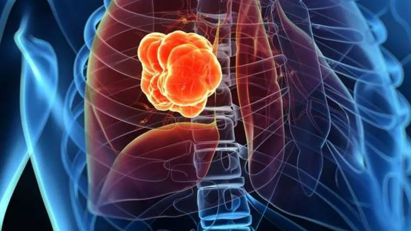 سرطان الرئة