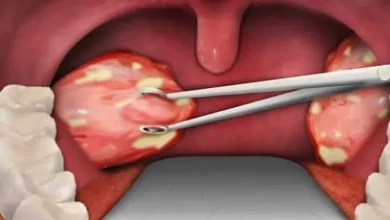 التهاب اللوزتين - أرشيفية