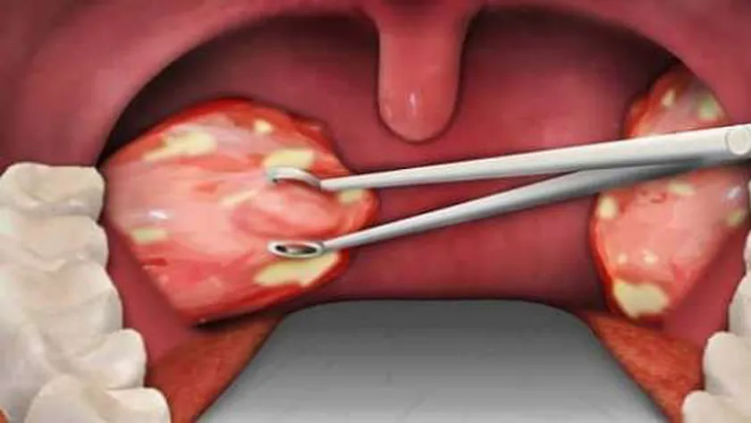 التهاب اللوزتين - أرشيفية